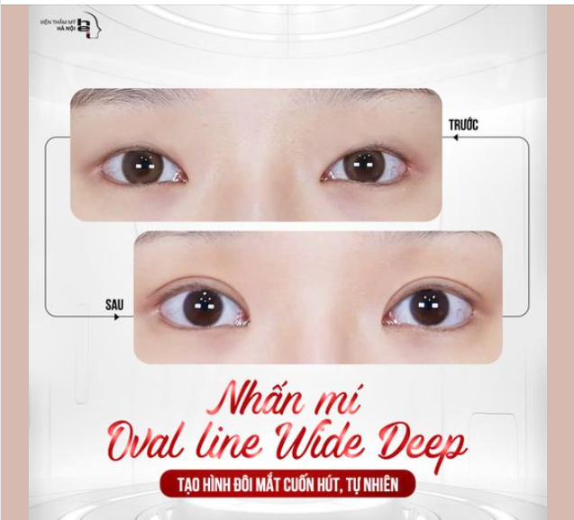 NHẤN MÍ OVAL LINE WIDE DEEP