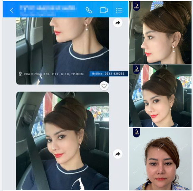 Đầu tháng với chiếc feedback xinh đẹp từ khách yêu Chị khách tự tin sau 8 tháng khắc phục mũi hỏng