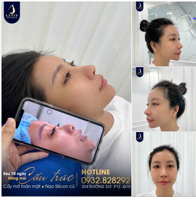 Chấm dứt chuỗi ngày lo lắng vì mũi có chứa sillicon, em gái tự tin và hạnh phúc với nhan sắc mới của mình.