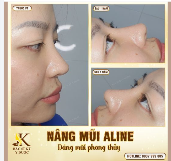 Thay đổi góc nghiêng sau phẫu thuật NÂNG MŨI ALINE tại BÁC SĨ KỲ Y DƯỢC