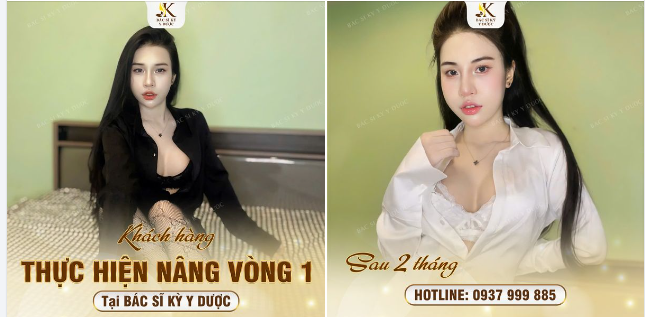 NÂNG V1 SỚM - ĐẸP SỚM Phẫu thuật được thực hiện tại bệnh viện