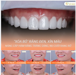 "XÓA BỎ" RĂNG ĐEN, XỈN MÀU - NÂNG CẤP HÀM RĂNG TRẮNG SÁNG, NỤ CƯỜI RẠNG RỠ