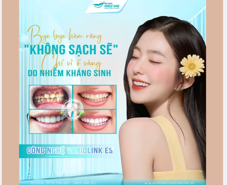 BYE BYE HÀM RĂNG KHÔNG SẠCH SẼ CHỈ VÌ Ố VÀNG DO NHIỄM KHÁNG SINH