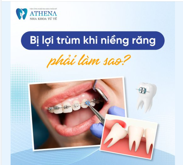 Bị lợi trùm khi làm răng phải làm sao?