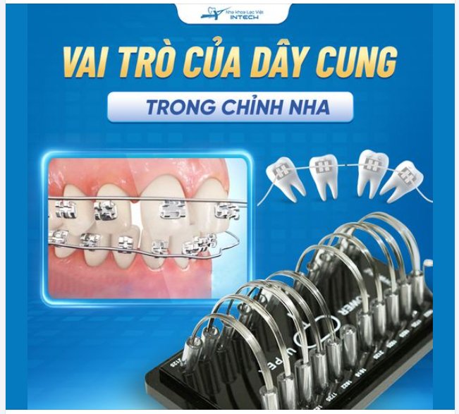 4 VAI TRÒ QUAN TRỌNG CỦA DÂY CUNG TRONG CHỈNH NHA MÀ BẠN CẦN BIẾT