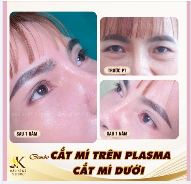 Ngày nào cũng có mắt xinh với combo CẮT MÍ TRÊN PLASMA + CẮT MÍ DƯỚI