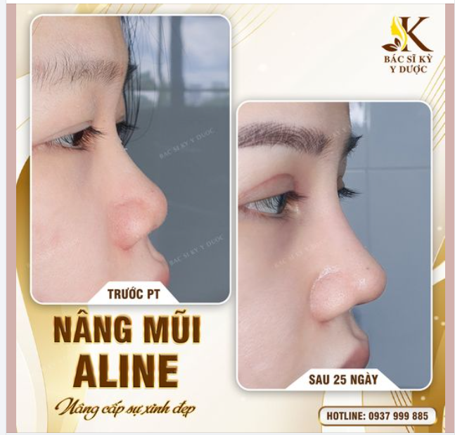 Dáng mũi ALINE sau 25 ngày thực hiện, vô cùng xinh xắn.