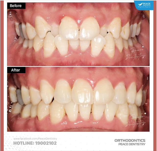 TẠO KHOẢNG TRONG CHỈNH NHA