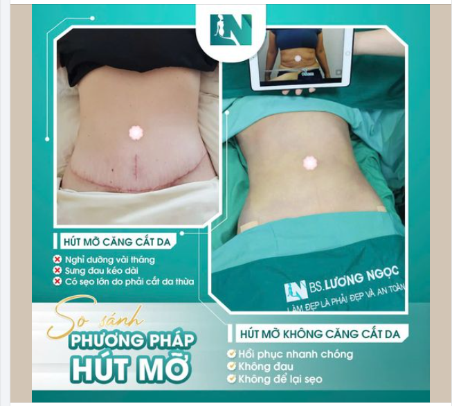 NHIỀU CHỊ EM ĐÃ PHẢI HỐI HẬN KHI THỰC HIỆN HÚT MỠ CẮT DA!!!