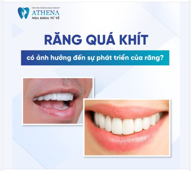 Răng quá khít không chỉ ảnh hưởng đến thẩm mỹ mà còn gây ra nhiều vấn đề sức khỏe răng miệng nghiêm trọng.