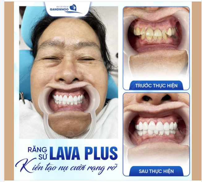 RĂNG SỨ LAVA PLUS - KIẾN TẠO NỤ CƯỜI HOÀN MỸ