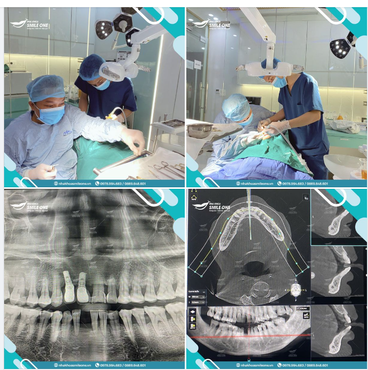 TRỒNG RĂNG IMPLANT, PHỤC HÌNH RĂNG MẤT, ĂN NHAI NHƯ RĂNG THẬT