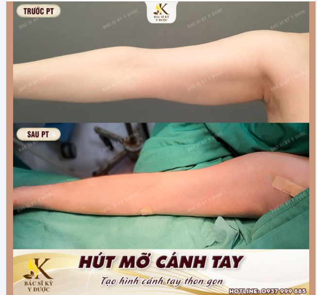 HÚT MỠ CÁNH TAY chưa bao giờ hết HOT