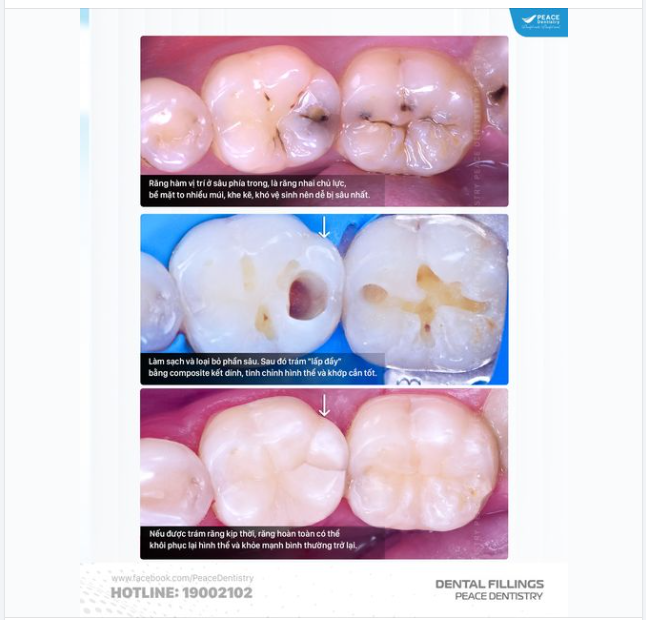 LỖ SÂU NHỎ nhưng lại là VẤN ĐỀ LỚN khi không được điều trị kịp thời