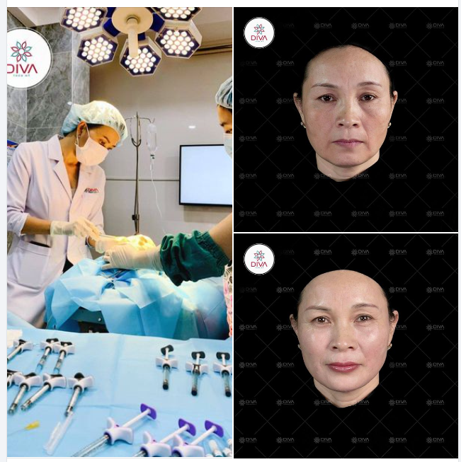 THỰC HIỆN MD CODES VỚI SỐ LƯỢNG F.ILLER NHIỀU THÌ CÓ LÀM MẶT BỊ PHÌNH TO RA KHÔNG?
