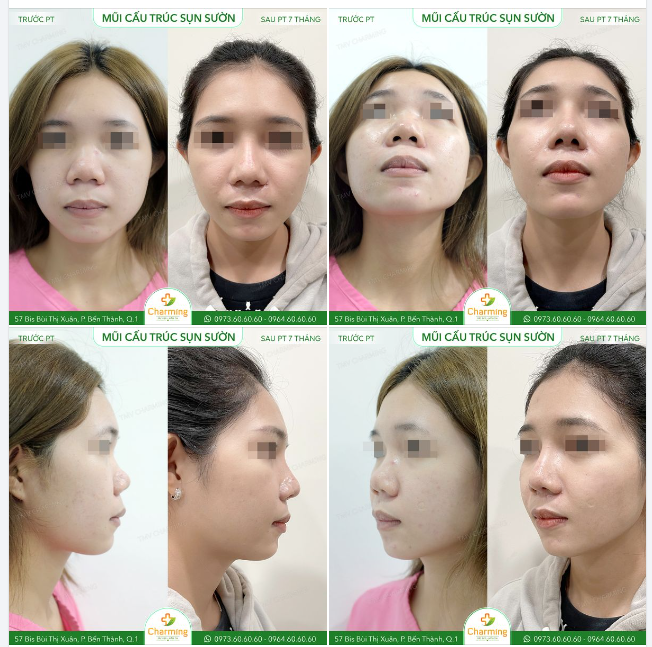 Khi nàng khách quyết định thực hiện nâng mũi cấu trúc sụn sườn, mục tiêu của nàng không chỉ là có một chiếc mũi cao mà còn là sự hài hòa và tự nhiên trên gương mặt.