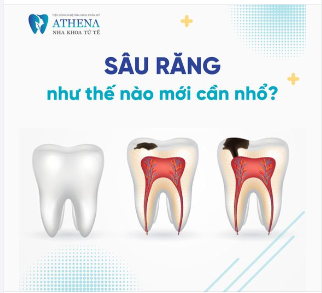 Sâu răng như thế nào mới cần nhổ?