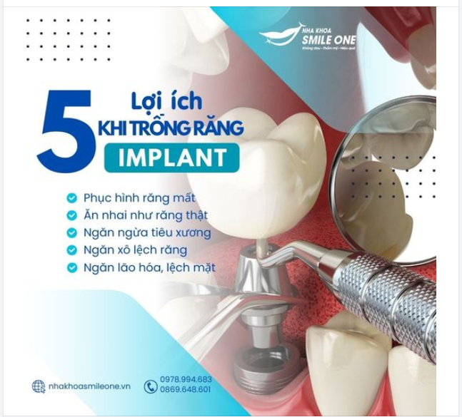 5 LỢI ÍCH KHI TRỒNG RĂNG IMPLANT BẠN ĐÃ BIẾT CHƯA?