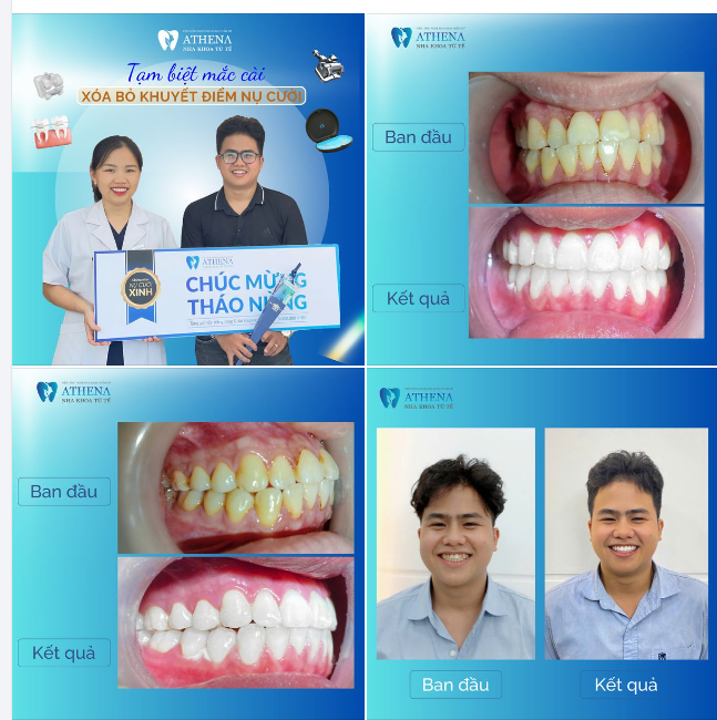 Tình trạng răng chen chúc, khấp khểnh không chỉ ảnh hưởng đến thẩm mỹ mà còn có thể gây ra nhiều vấn đề .