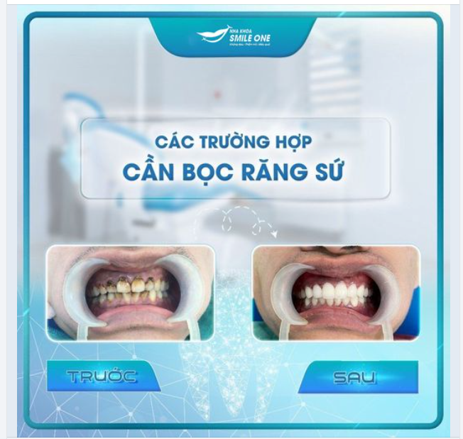 KHI NÀO RĂNG BẠN CẦN BỌC SỨ ĐÂY?