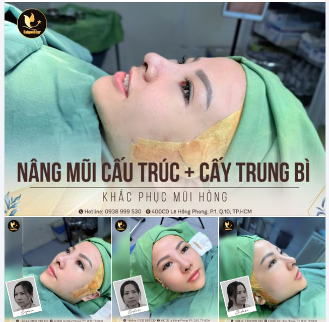 NÂNG MŨI CẤU TRÚC + CẤY TRUNG BÌ - SỬA LẠI MŨI HỎNG