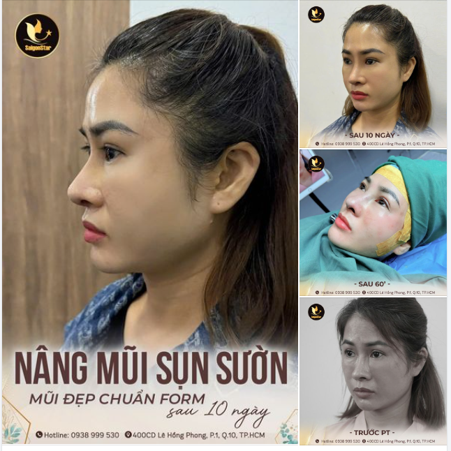 HÀNH TRÌNH 10 NGÀY NÂNG MŨI SỤN SƯỜN - KHẮC PHỤC MŨI HỎNG