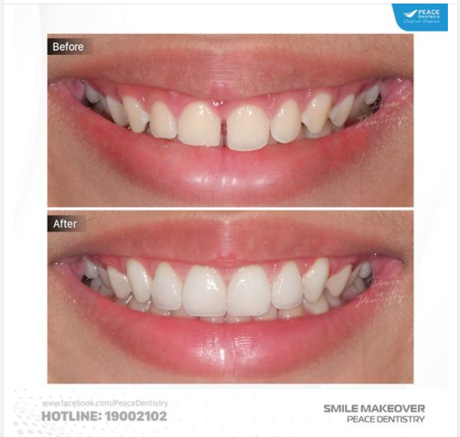VENEER ĐÓNG KHE THƯA RĂNG CỬA, ĐIỀU CHỈNH HÌNH THỂ RĂNG HÀI HOÀ VÀ TỰ NHIÊN