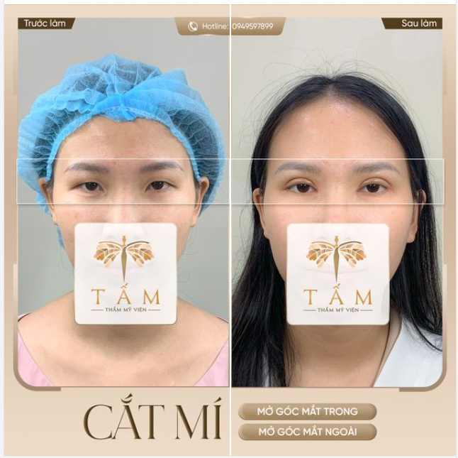 Hình ảnh chân thực khách hàng sử dụng dịch vụ Cắt Mí - Mở góc trong, góc ngoài tại TMV Tấm.