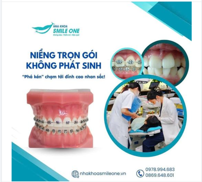 NIỀNG TRỌN GÓI, KHÔNG PHÁT SINH