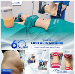 KIẾN TẠO EO THON CÙNG LIPO ULTRASOUND ĐẸP NHƯ THẾ NÀO?