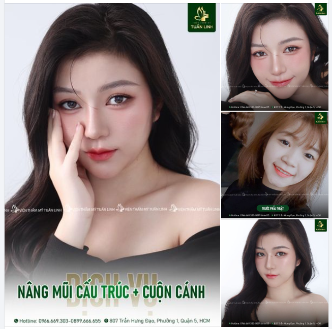Nâng mũi cấu trúc kết hợp cuộn cánh – Mũi đẹp hoàn hảo, chinh phục mọi ánh nhìn!!!