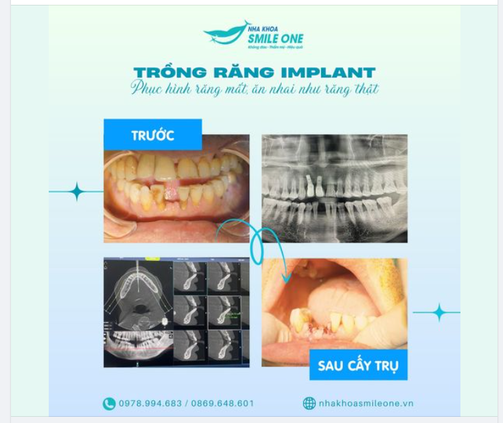 XỬ LÝ HÀM RĂNG "LỌT GIÓ" THẾ NÀO ĐÂY?