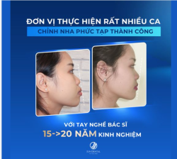 "Răng em quá xấu để làm sứ, có làm cũng không thể đẹp được nên đã chuyển hướng và tìm hiểu niềng răng" - Bạn Lê Thủy chia sẻ trong hôm tháo niềng