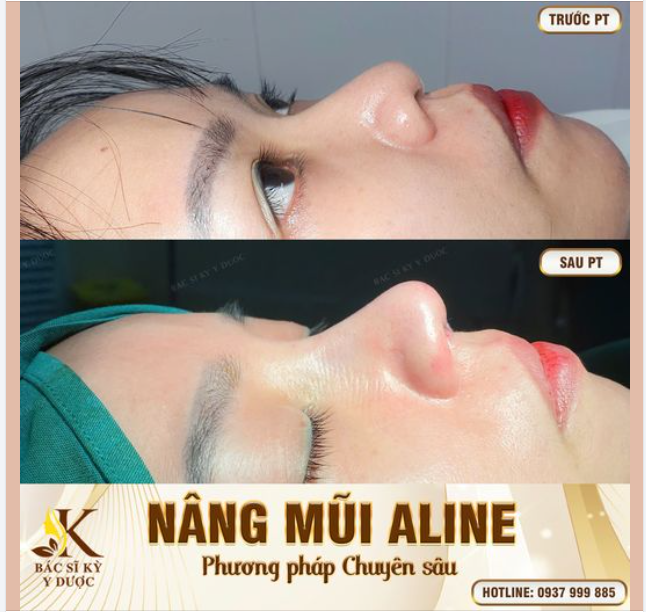 "ZOOM" cận cảnh SAU 60 phút NÂNG MŨI ALINE tại BÁC SĨ KỲ Y DƯỢC