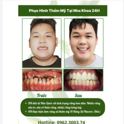 PHỤC HÌNH THẪM MỸ TẠI NHA KHOA 24H