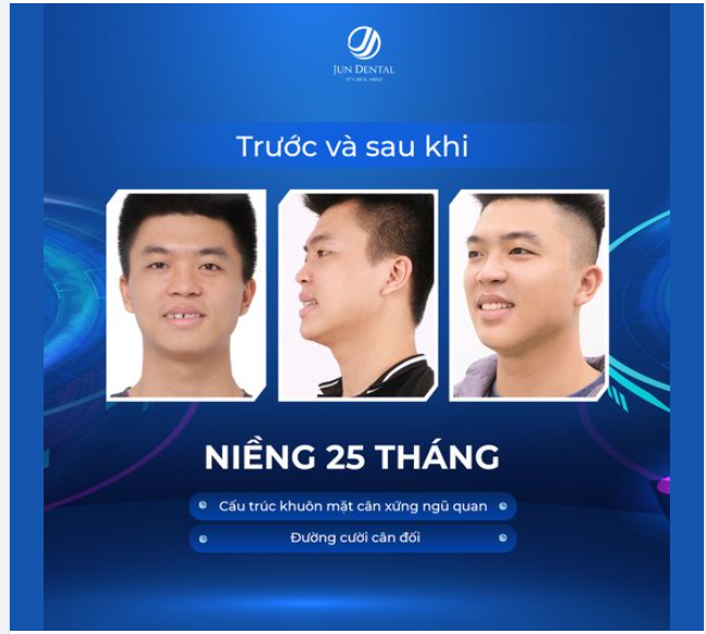 NIỀNG RĂNG MẮC CÀI KIM LOẠI ĐÁNH BAY HÔ MÓM  ƯU ĐÃI LÊN TỚI 25% CHỈ TRONG THÁNG 10