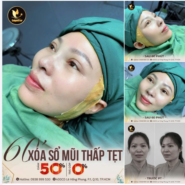 NÂNG MŨI CẤU TRÚC - XÓA BỎ NỖI TỰ TI MŨI THẤP TẸT, TO BÈ CHỈ SAU 60 PHÚT!!!