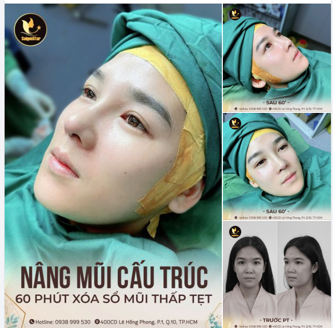 NÀNG NÀO ĐANG CÒN TỰ TI VÌ CHIẾC MŨI THẤP TẸT CỦA MÌNH???
