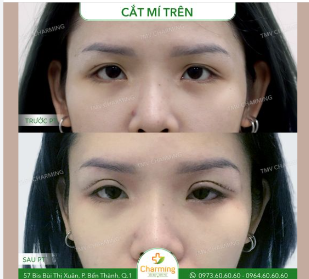 Nàng khách quyết định thực hiện cắt mí trên để cải thiện tình trạng mí mắt của mình.