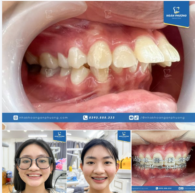 Cùng Bảo Thanh tạm biết răng mái mưa trong truyền thuyết