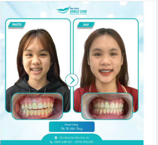 Chúc bạn có một hàm răng trắng sáng và khỏe mạnh nhé!