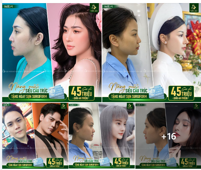 KHUYẾN MÃI ĐẶC BIỆT DỊP 20/10: NÂNG MŨI SIÊU CẤU TRÚC TẶNG SỤN NHÂN TẠO CAO CẤP SURGIFORM