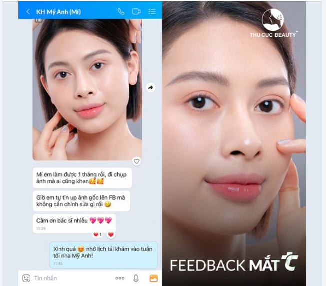 "Nhả vía" cho các chị em mí lót, mí lệch, đa nếp mí