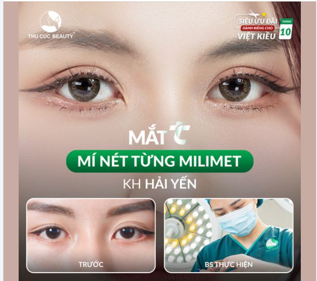 Tặng đến 5 chỉ vàng 9999 khi cắt mí Siêu ưu đãi dành riêng cho Kiều Bào