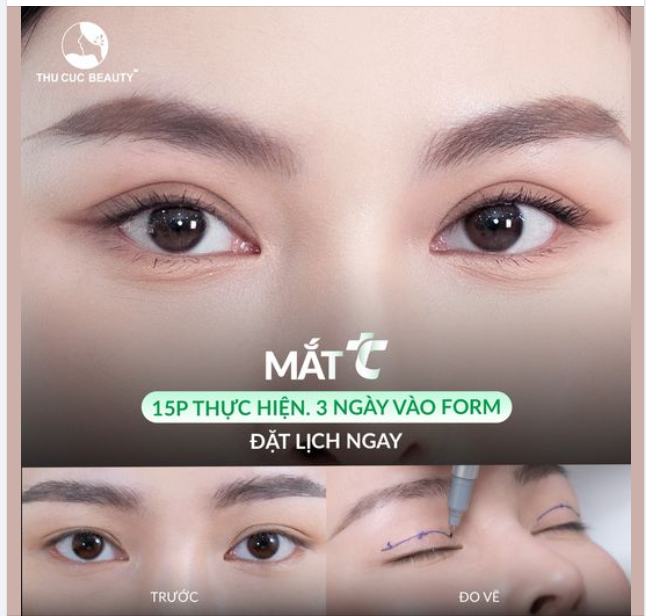 Cắt mí ngay để có đôi mắt đẹp đón tết