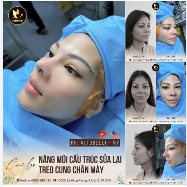 COMBO NÂNG MŨI SỬA LẠI + TREO CUNG CHÂN MÀY KH. ALTOBELLI (MỸ)