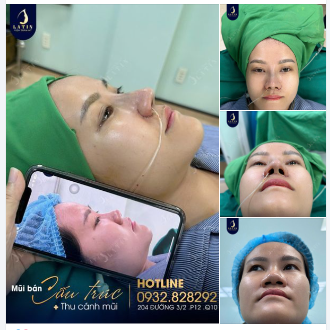 Mũi bán cấu trúc vừa hoàn thành cho em gái
