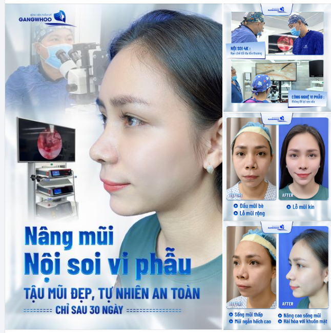 NÂNG MŨI NỘI SOI VI PHẪU TẬU MŨI ĐẸP TỰ NHIÊN AN TOÀN SAU 30 NGÀY