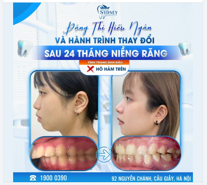 H.NGÂN VÀ HÀNH TRÌNH THAY ĐỔI SAU 24 THÁNG NIỀNG RĂNG