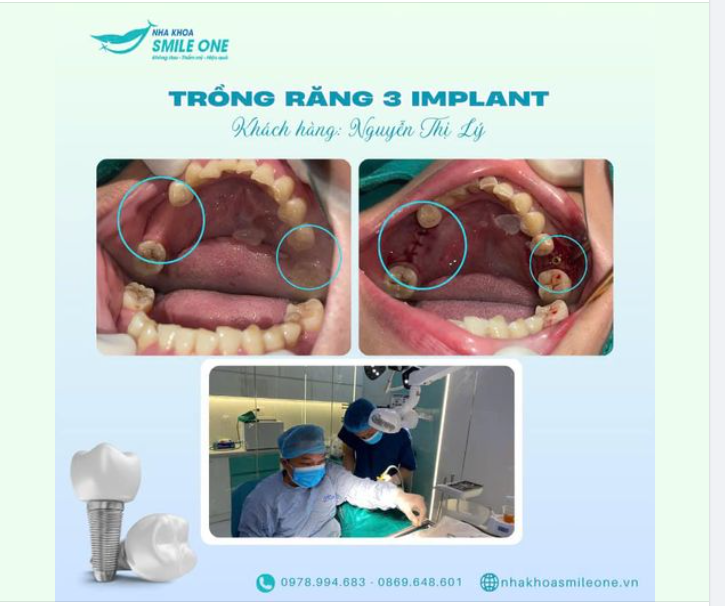 TRỒNG 3 RĂNG IMPLANT, KHẮC PHỤC RĂNG MẤT